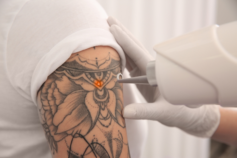 Laser rejuvenescimento e retirada de tatoo